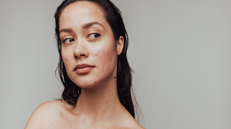 The Best Skincare for Acne